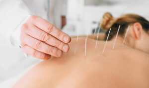 acupuncture therapy