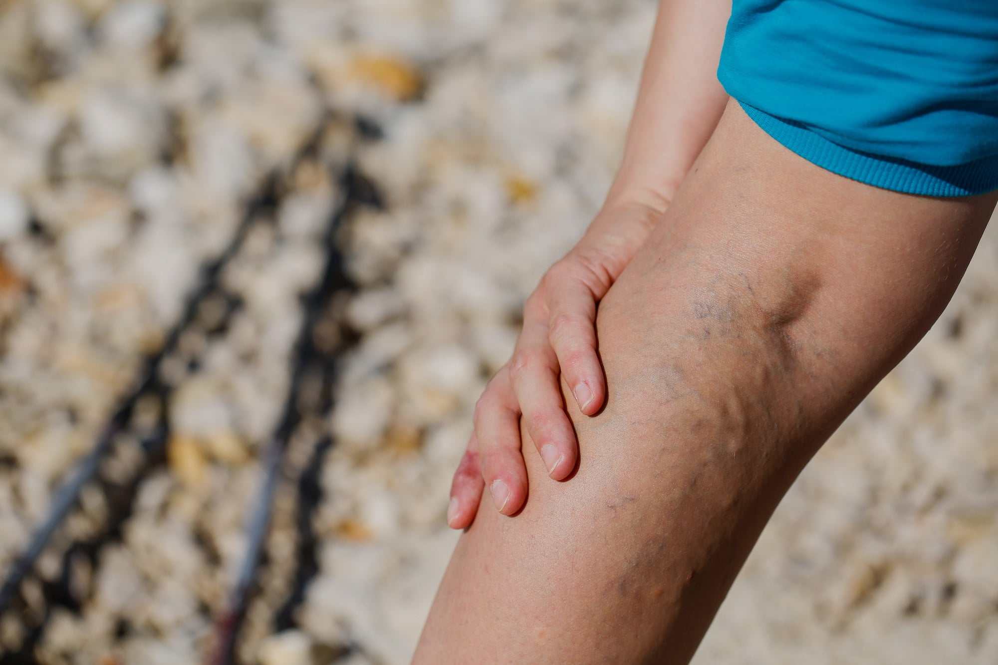 Varicose veins affecting the leg of an elderly man - Stock Image