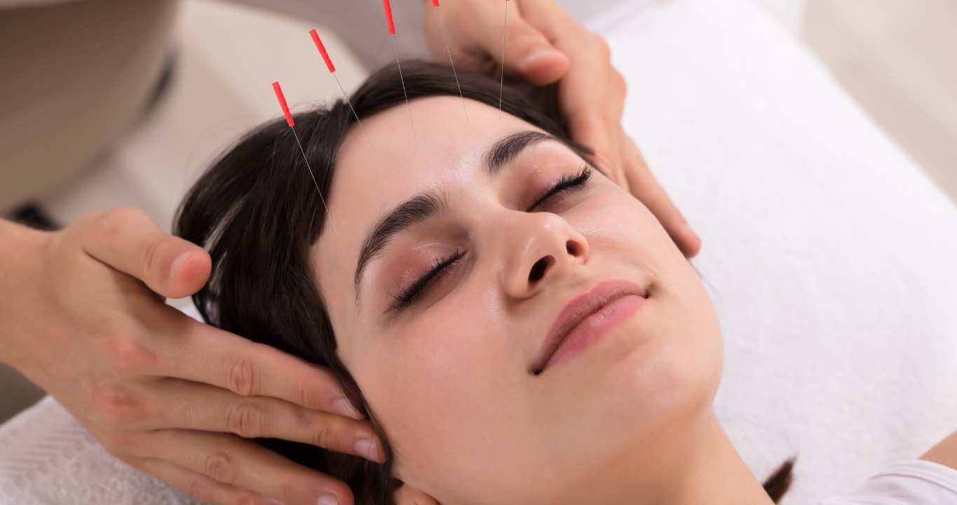 Acupuncture For Chronic Migraines