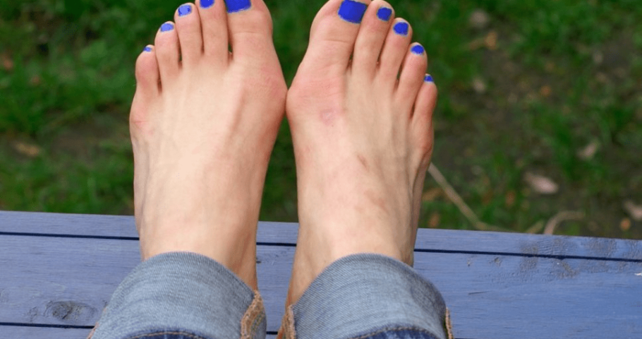 Bunion, Bunion Pain, Valgus Hallux, Minimally Invasive Bunion Surgery