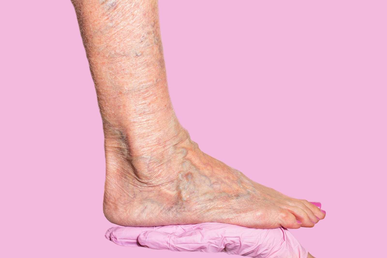 Don’t Ignore Leg Pain: Effective Treatments For Venous Insufficiency