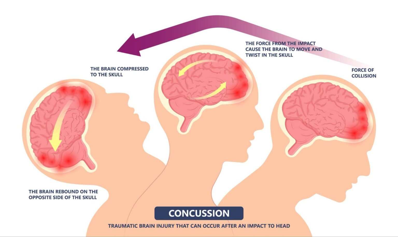 How to Know If You Have a Concussion - Alliance Orthopedics