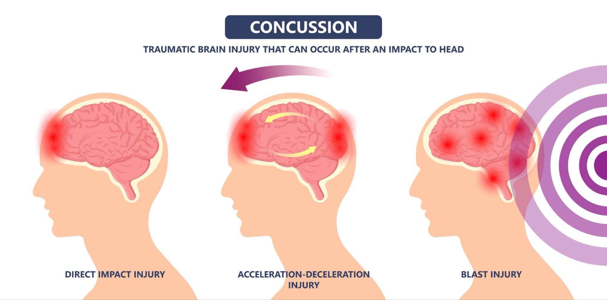 How to Know If You Have a Concussion - Alliance Orthopedics